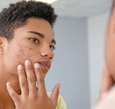 Teen boy looking in the mirror with acne concerns